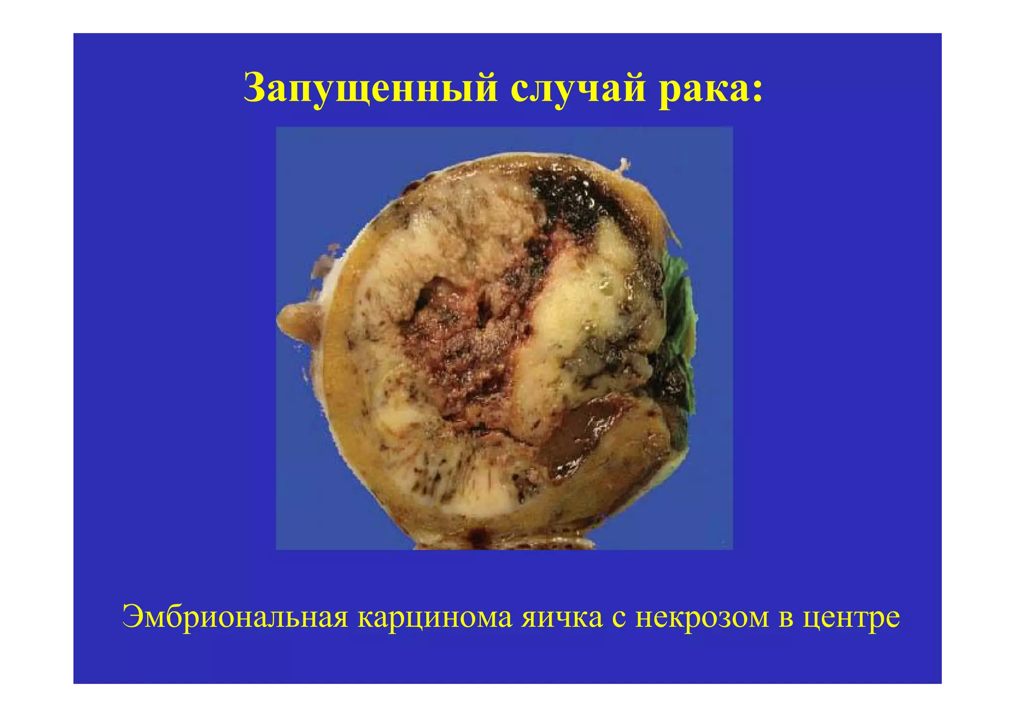Запущенный случай рака:




Эмбриональная карцинома яичка с некрозом в центре
 