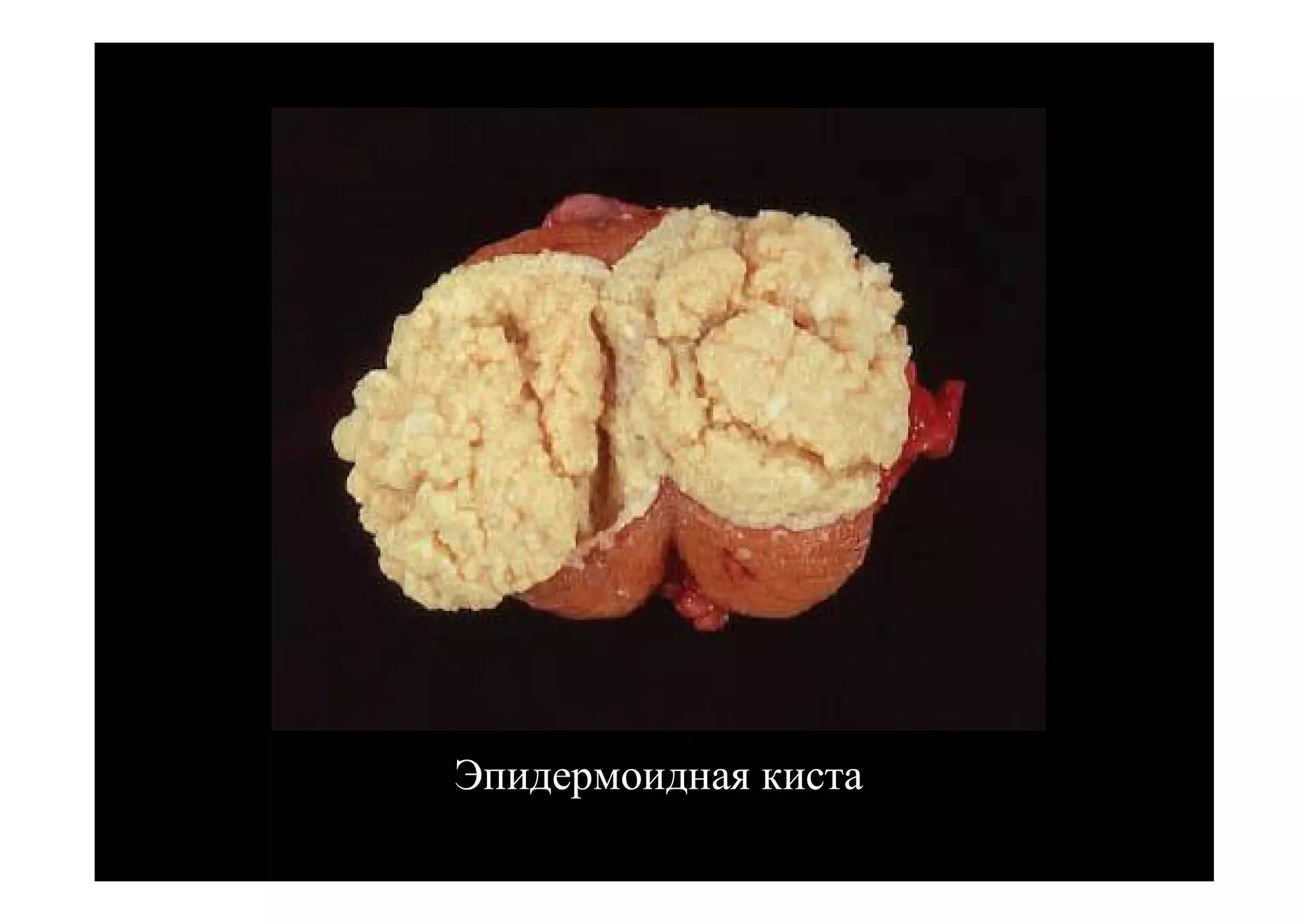 Эпидермоидная киста
 