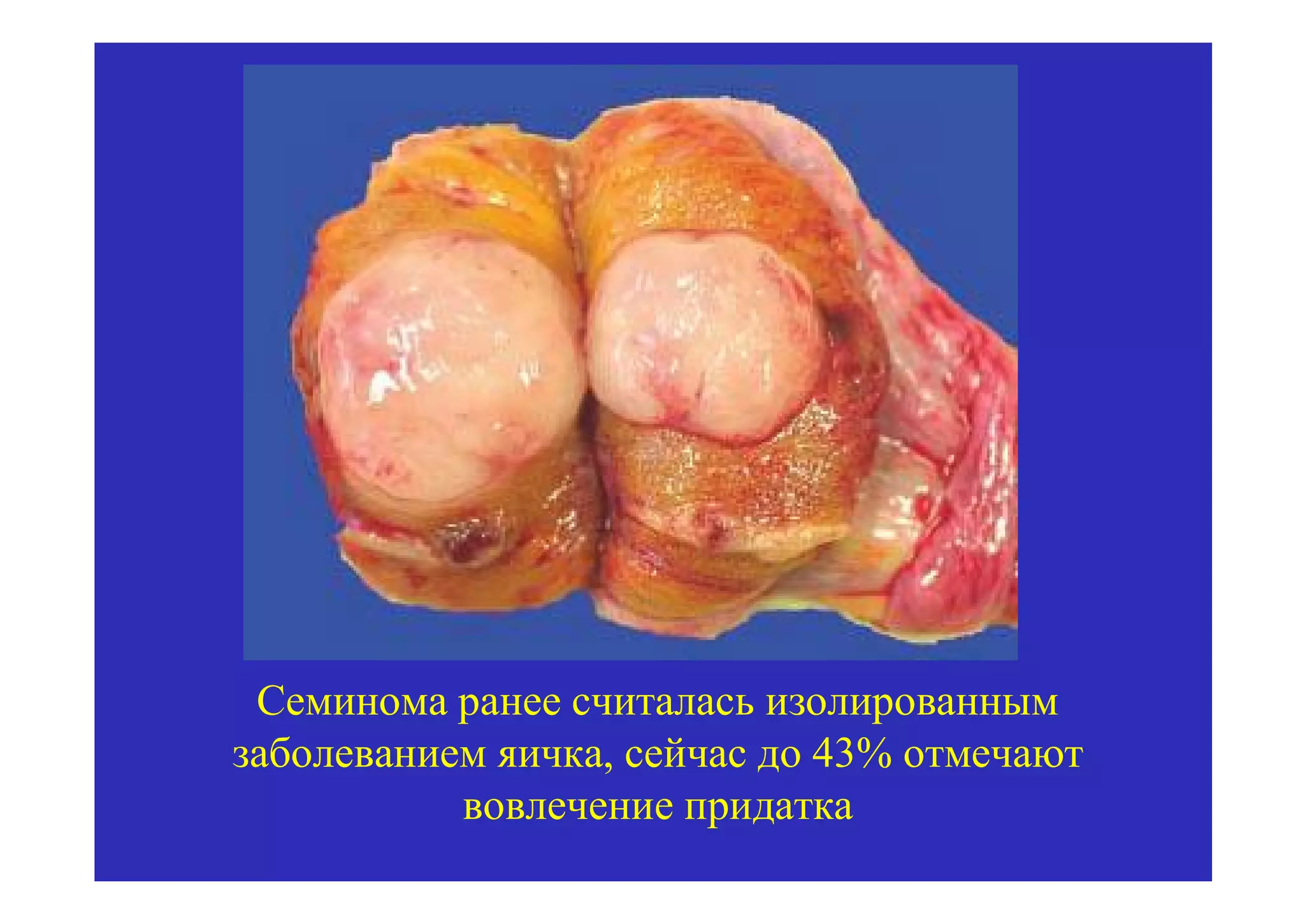 Семинома ранее считалась изолированным
заболеванием яичка, сейчас до 43% отмечают
           вовлечение придатка
 