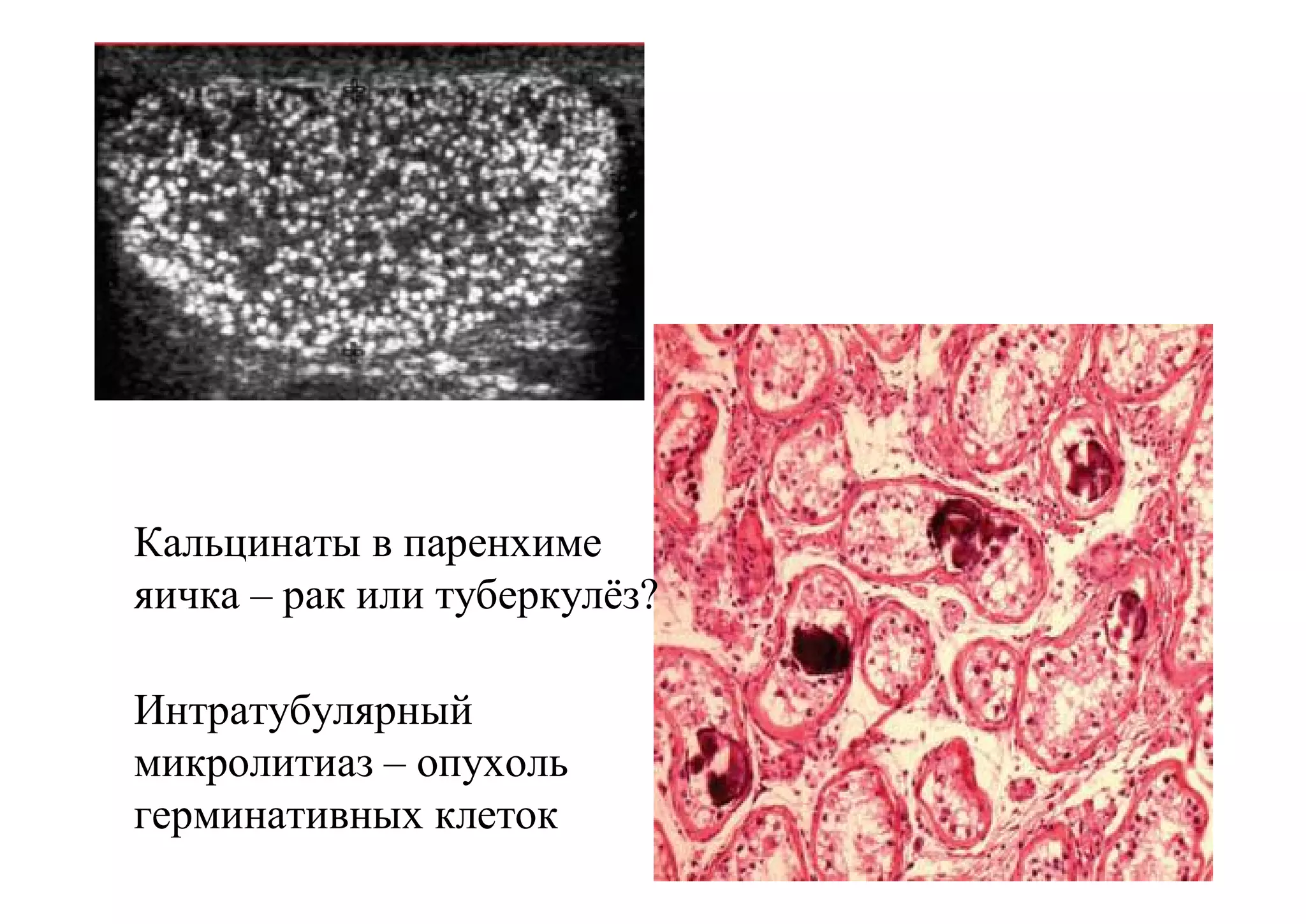 Кальцинаты в паренхиме
яичка – рак или туберкулёз?

Интратубулярный
микролитиаз – опухоль
герминативных клеток
 