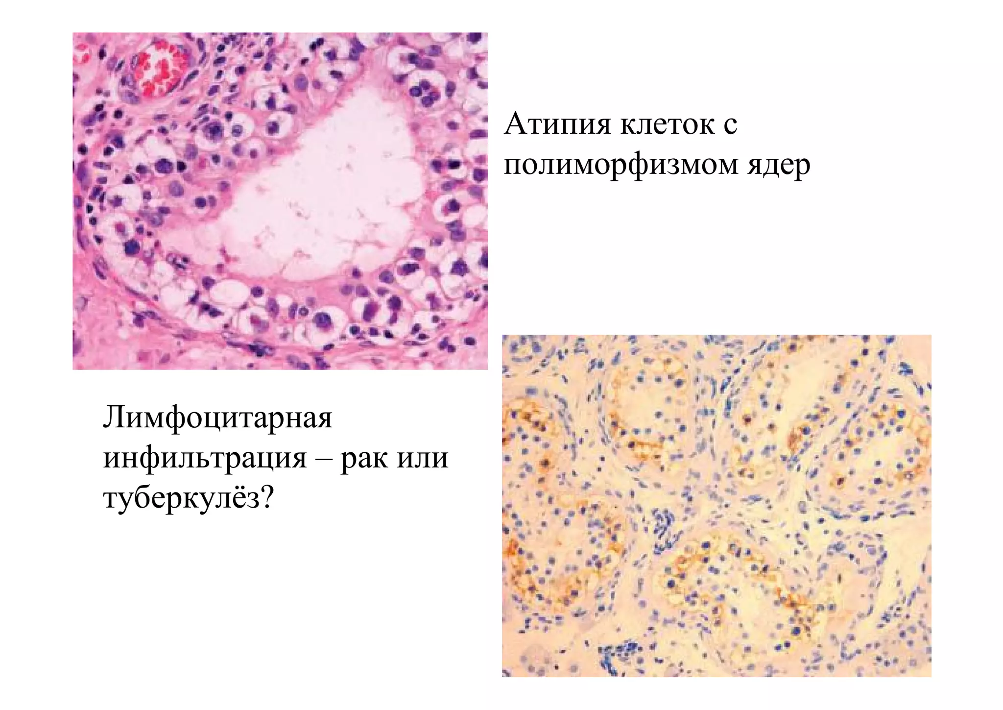 Атипия клеток с
                         полиморфизмом ядер




Лимфоцитарная
инфильтрация – рак или
туберкулёз?
 