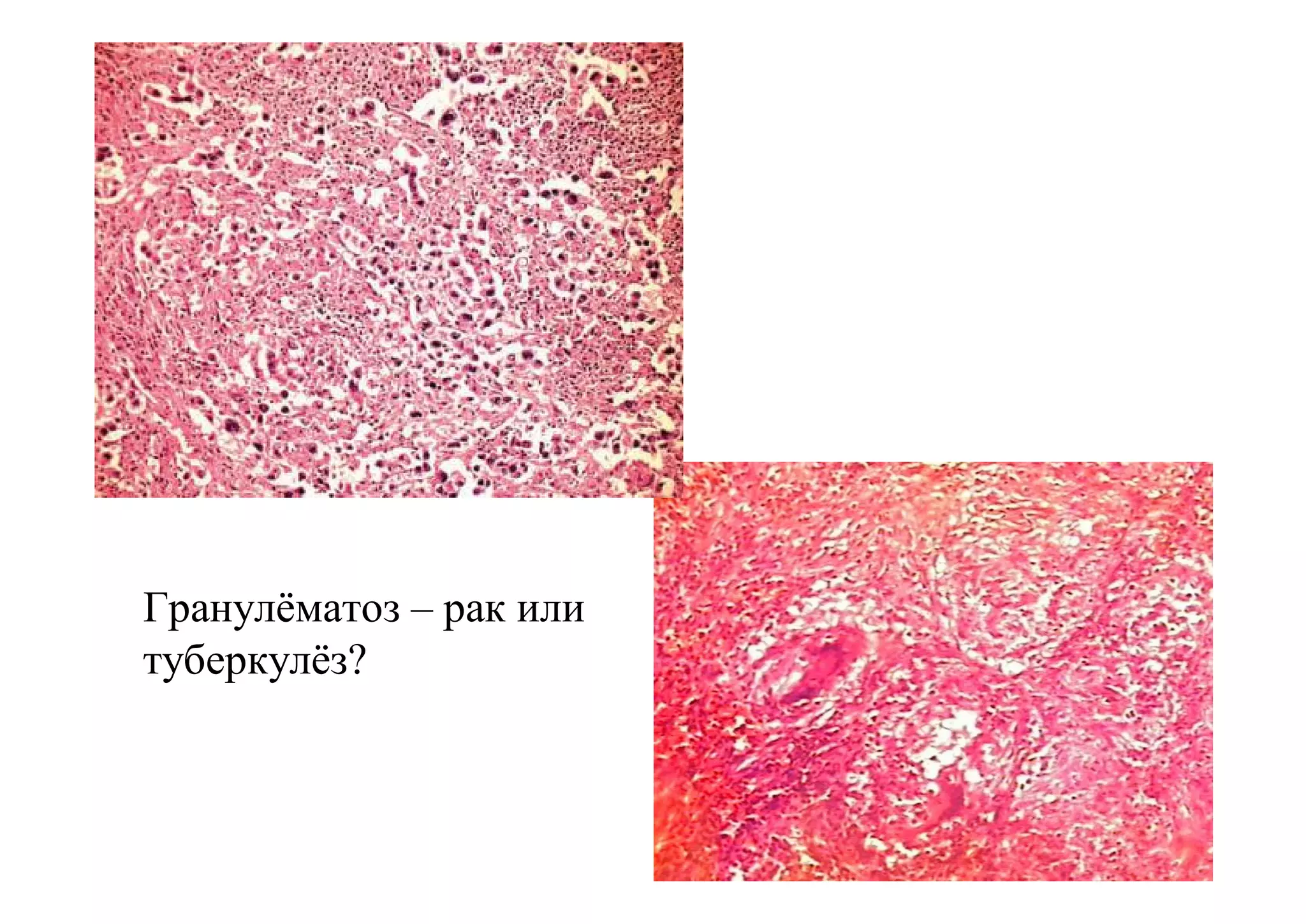 Гранулёматоз – рак или
туберкулёз?
 