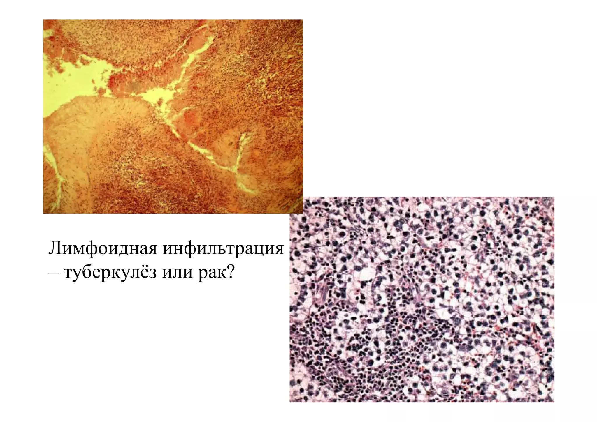 Лимфоидная инфильтрация
– туберкулёз или рак?
 