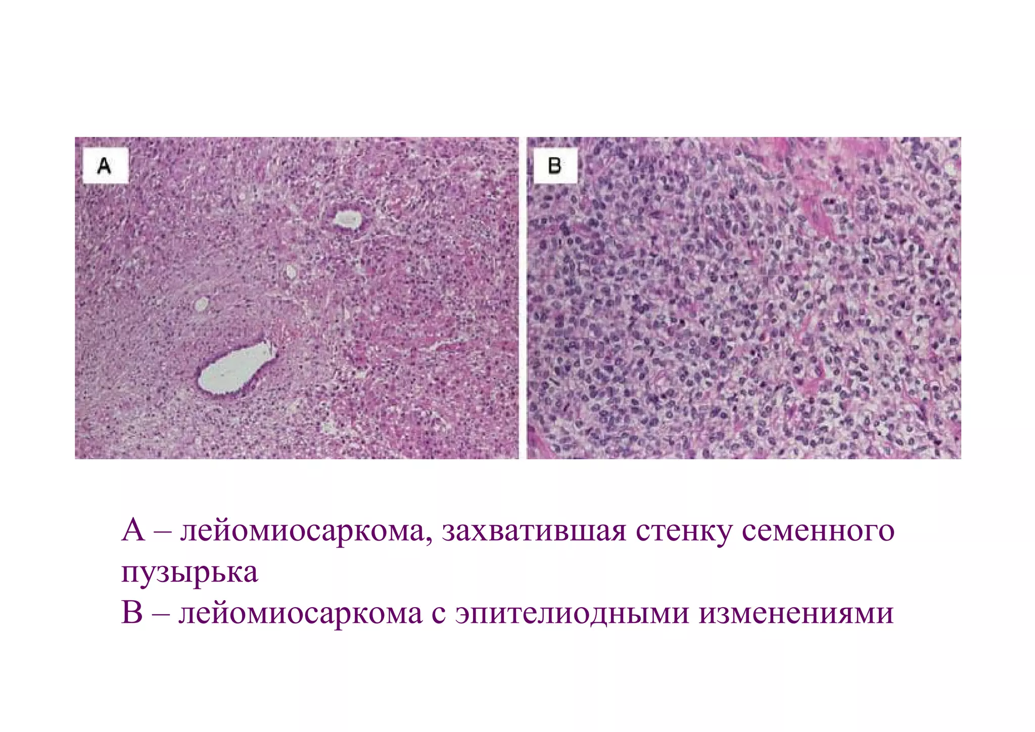 А – лейомиосаркома, захватившая стенку семенного
пузырька
В – лейомиосаркома с эпителиодными изменениями
 