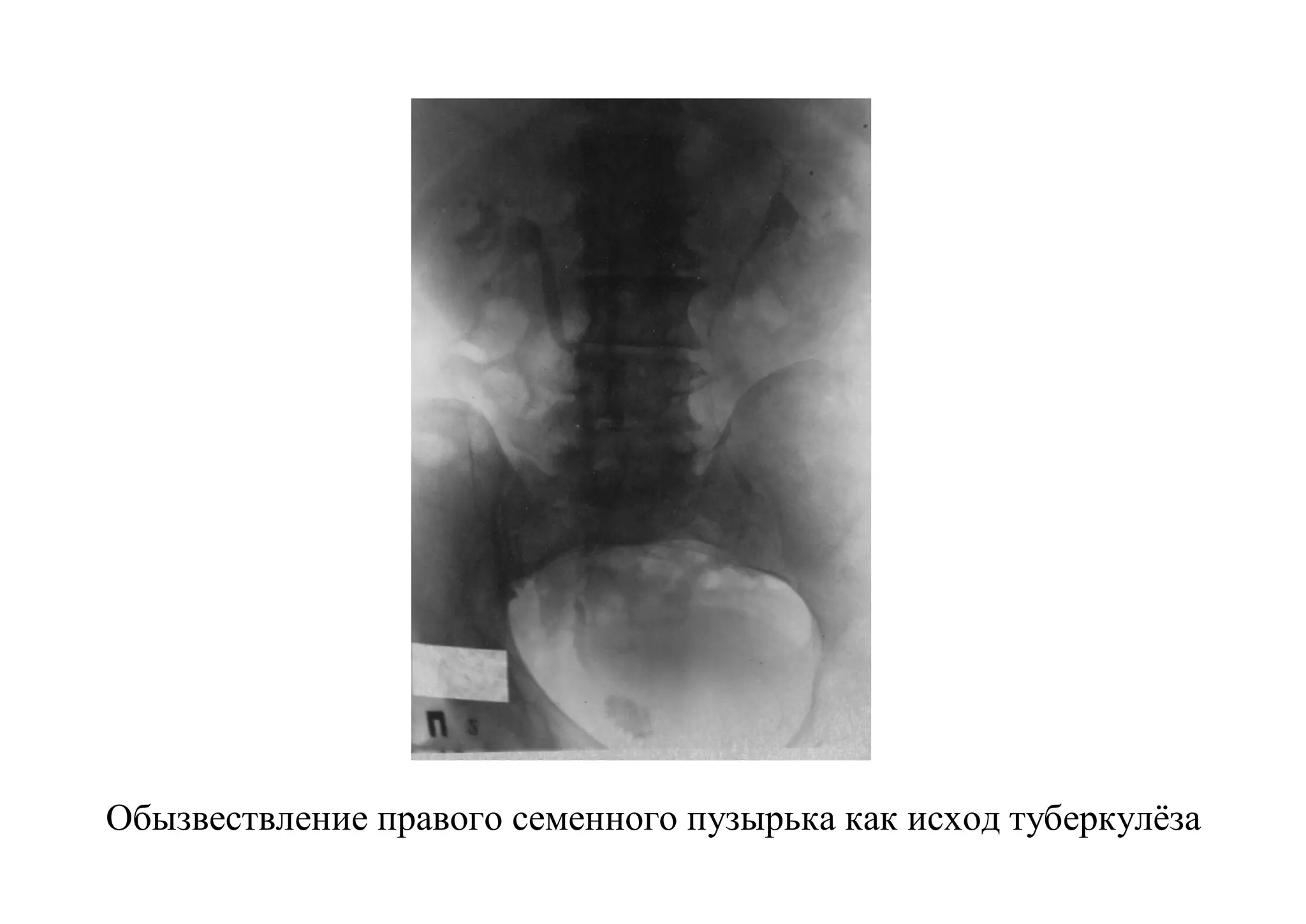 Обызвествление правого семенного пузырька как исход туберкулёза
 