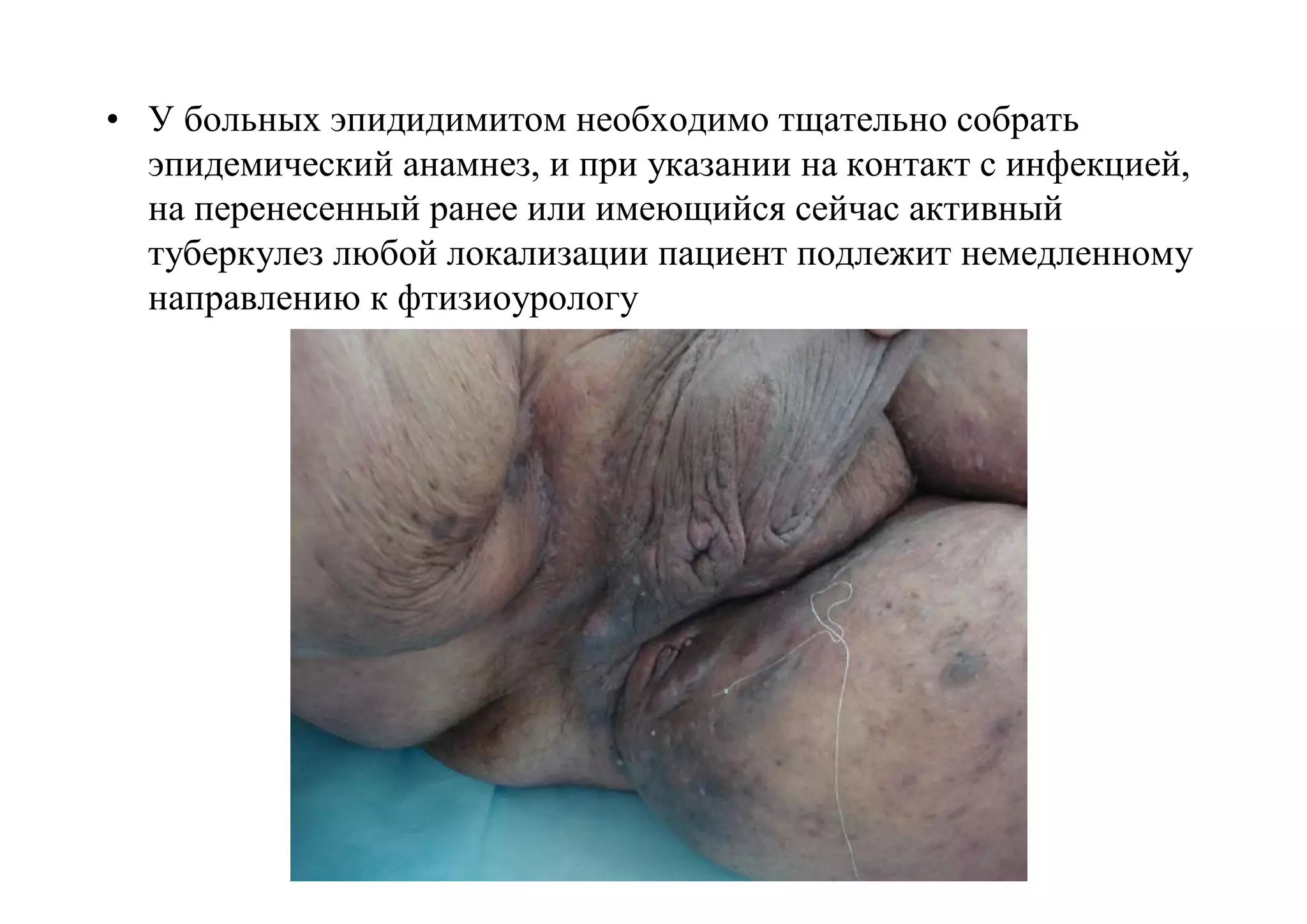 • У больных эпидидимитом необходимо тщательно собрать
  эпидемический анамнез, и при указании на контакт с инфекцией,
  на перенесенный ранее или имеющийся сейчас активный
  туберкулез любой локализации пациент подлежит немедленному
  направлению к фтизиоурологу
 
