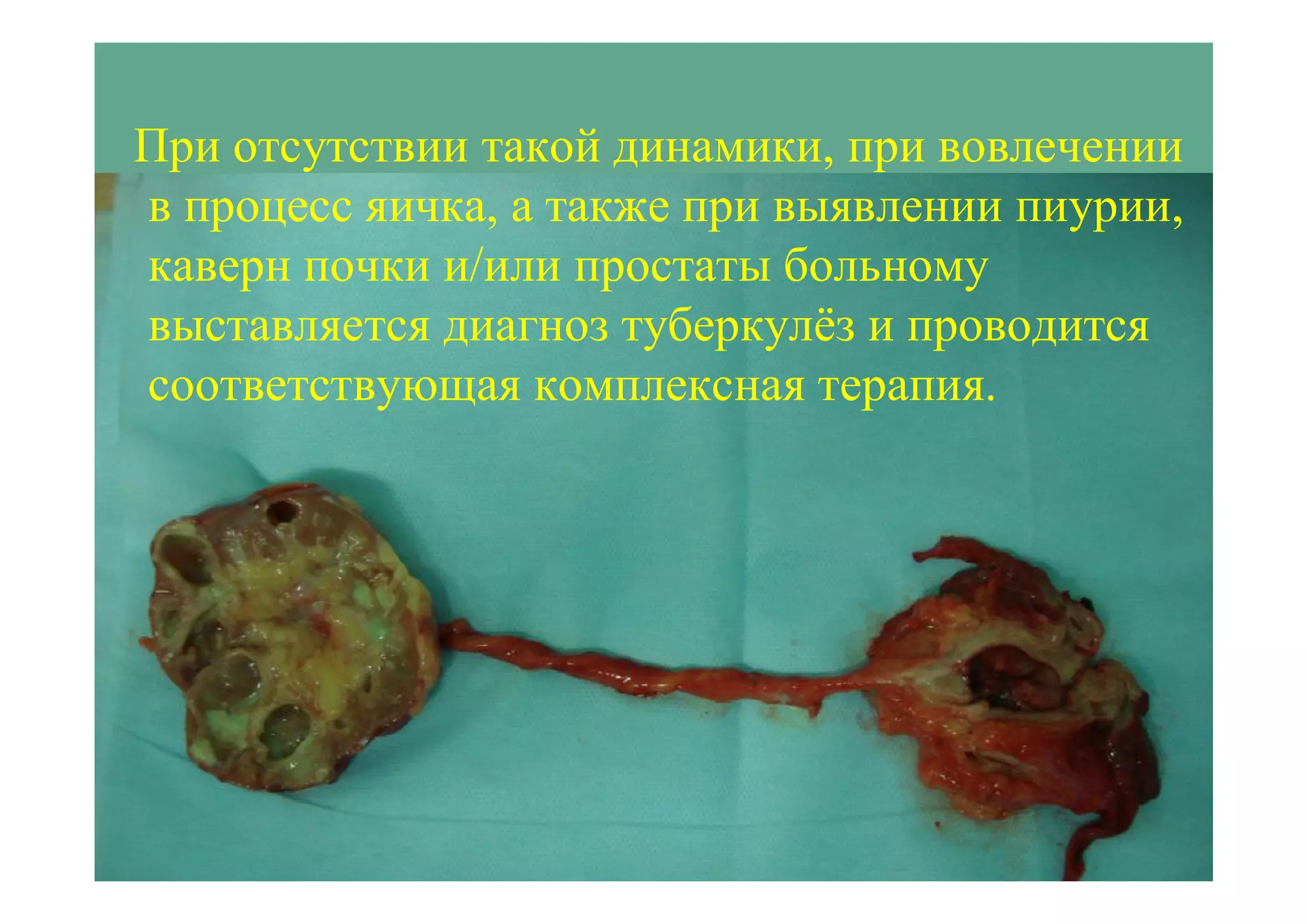 При отсутствии такой динамики, при вовлечении
в процесс яичка, а также при выявлении пиурии,
каверн почки и/или простаты больному
выставляется диагноз туберкулёз и проводится
соответствующая комплексная терапия.
 