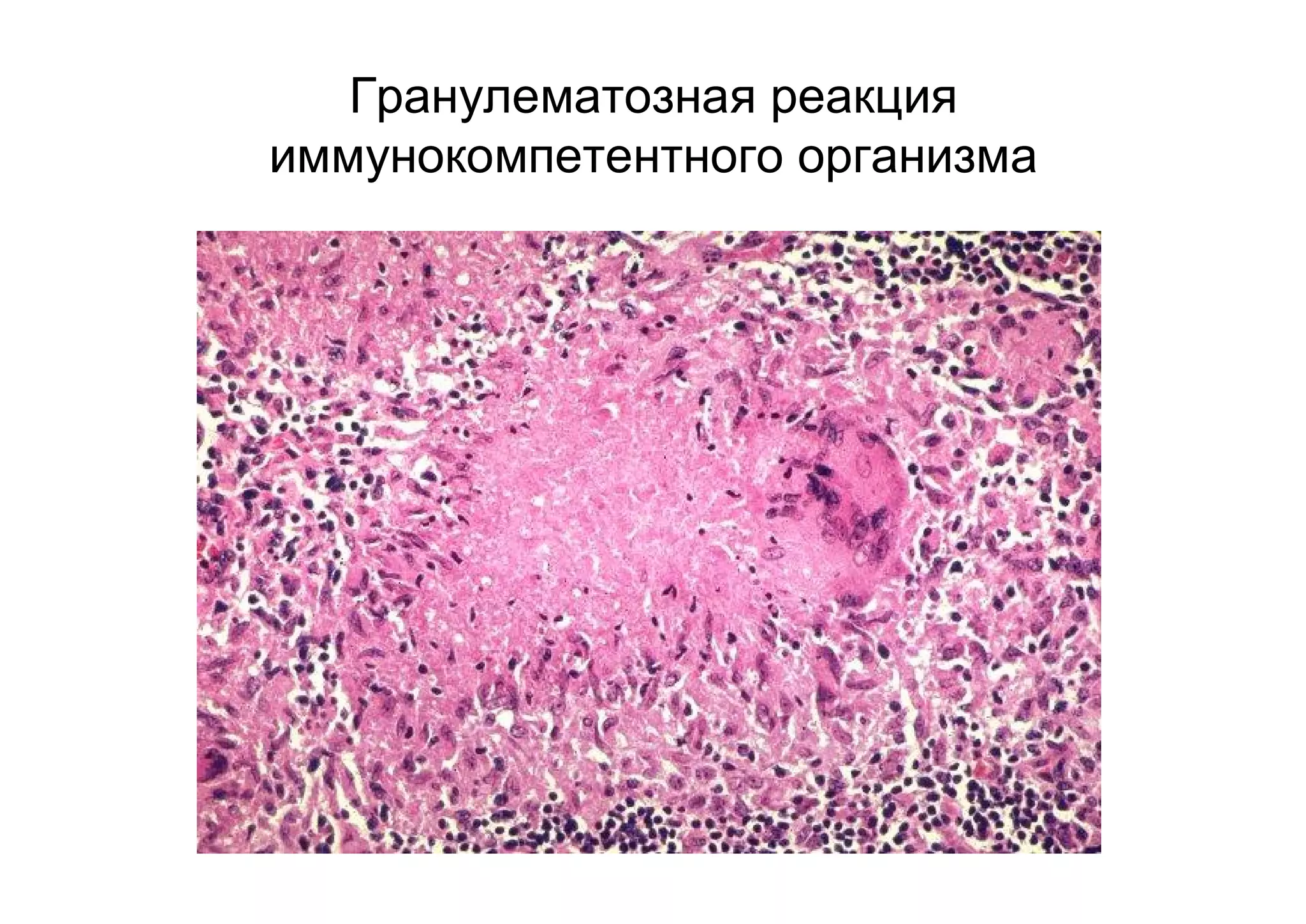 Гранулематозная реакция
иммунокомпетентного организма
 