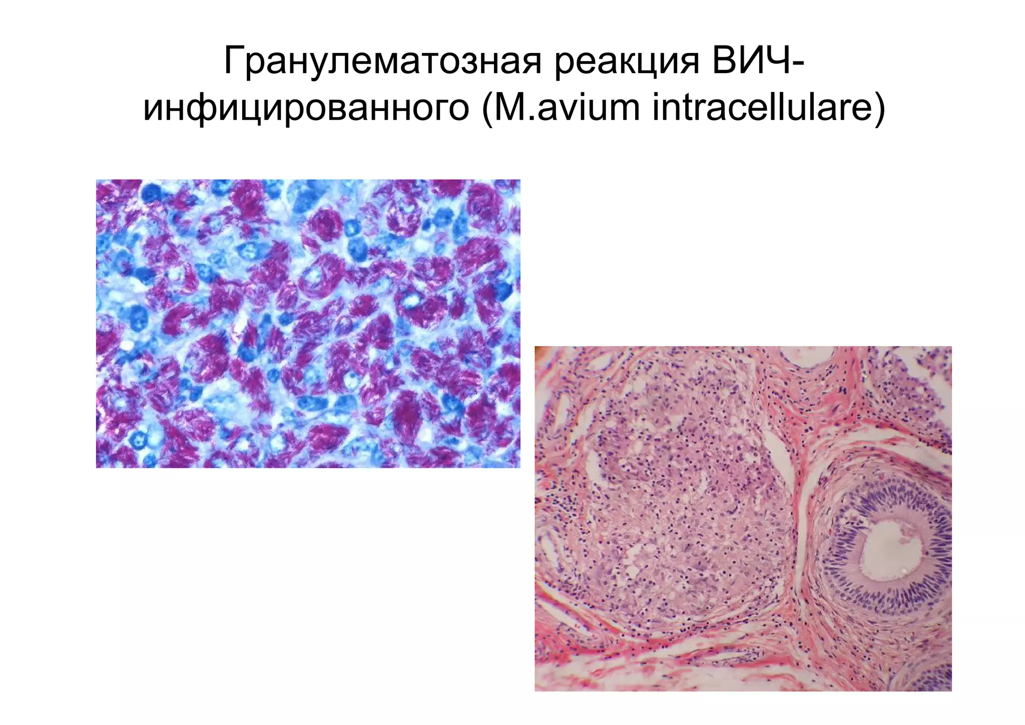 Гранулематозная реакция ВИЧ-
инфицированного (M.avium intracellulare)
 