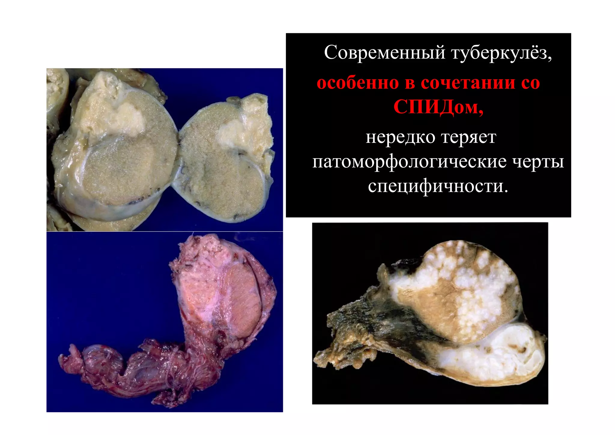 Современный туберкулёз,
особенно в сочетании со
        СПИДом,
     нередко теряет
патоморфологические черты
     специфичности.
 