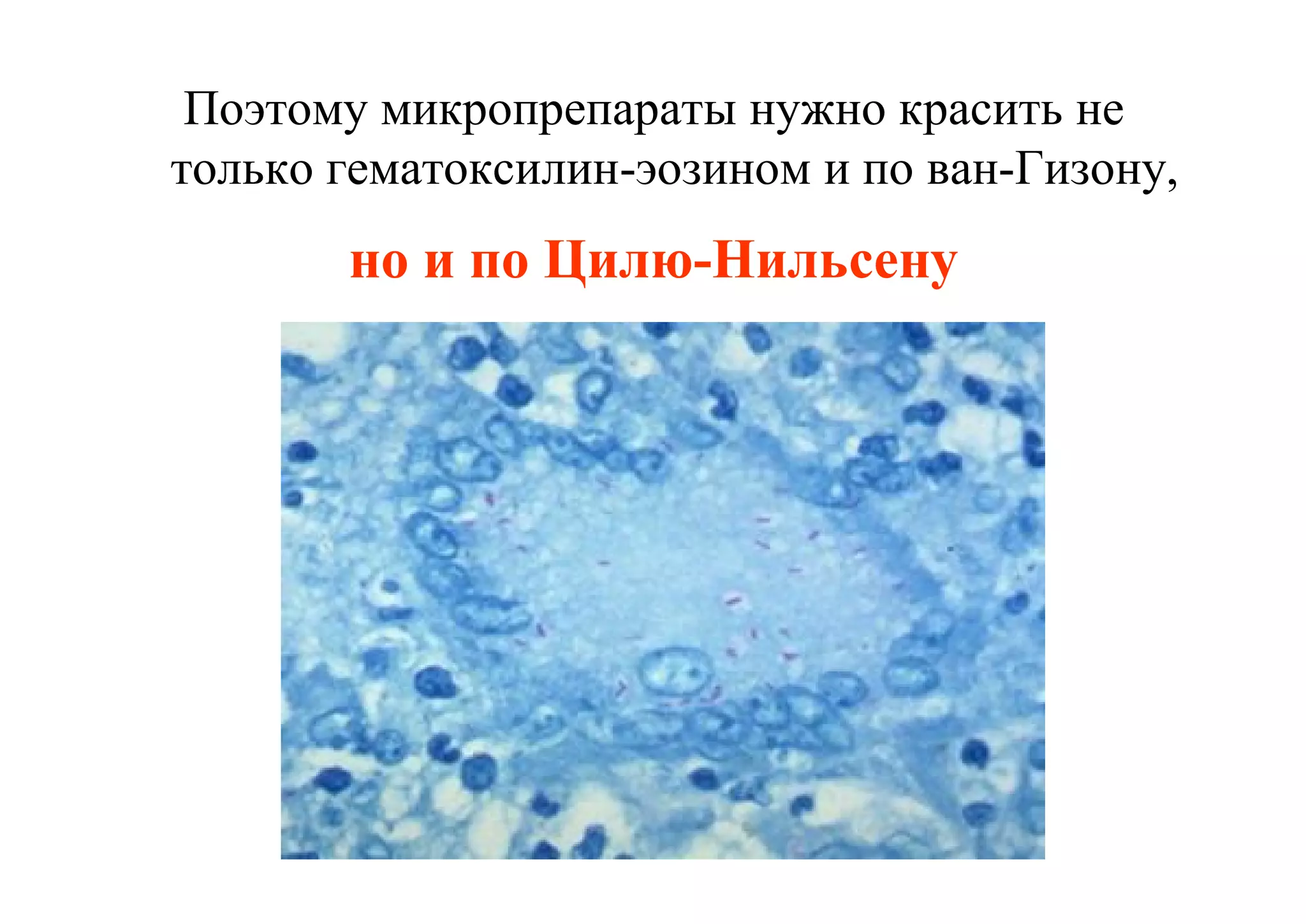 Поэтому микропрепараты нужно красить не
только гематоксилин-эозином и по ван-Гизону,
       но и по Цилю-Нильсену
 