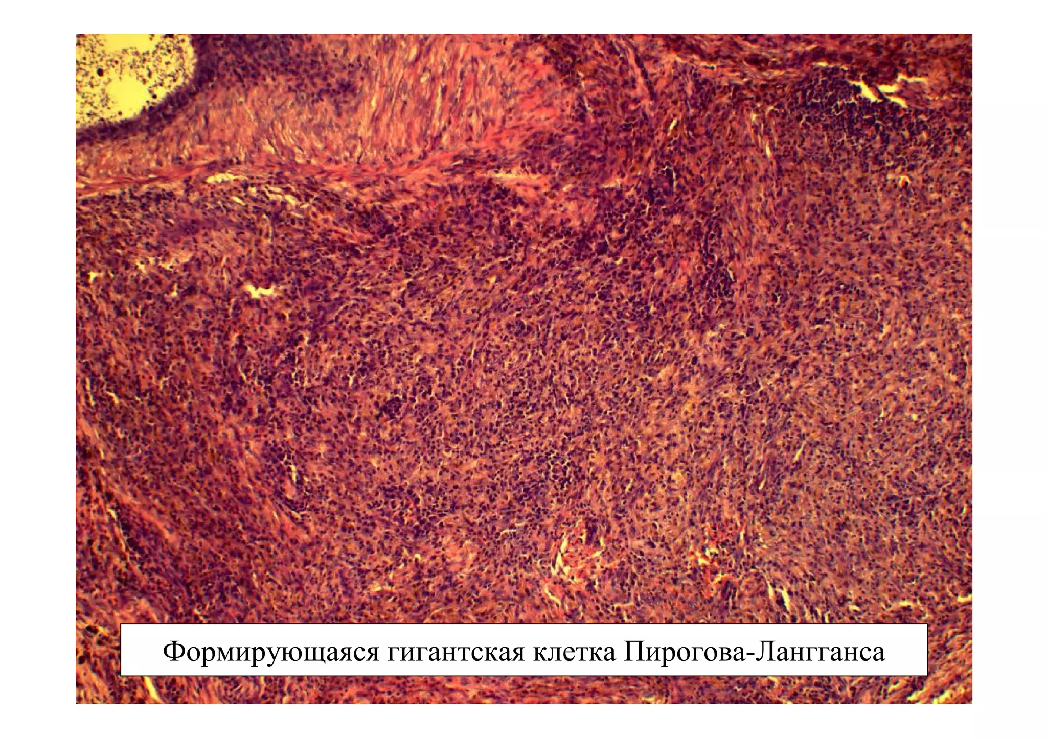 Формирующаяся гигантская клетка Пирогова-Лангганса
 