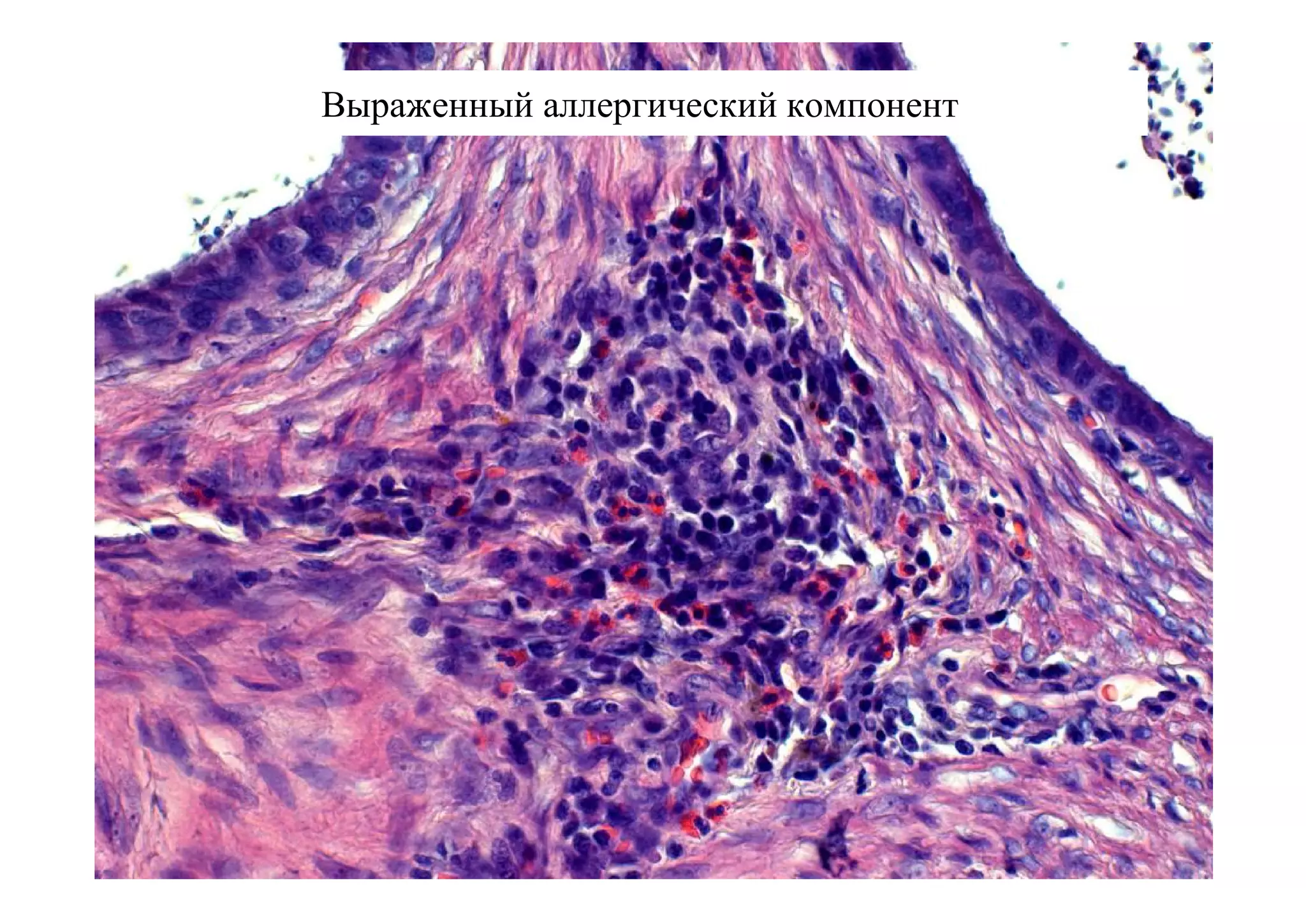 Выраженный аллергический компонент
 