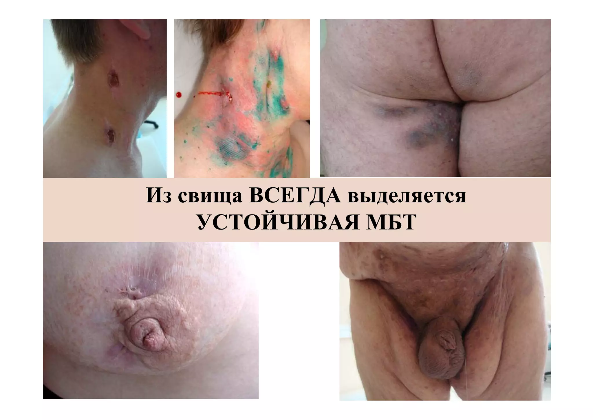 Из свища ВСЕГДА выделяется
     УСТОЙЧИВАЯ МБТ
 