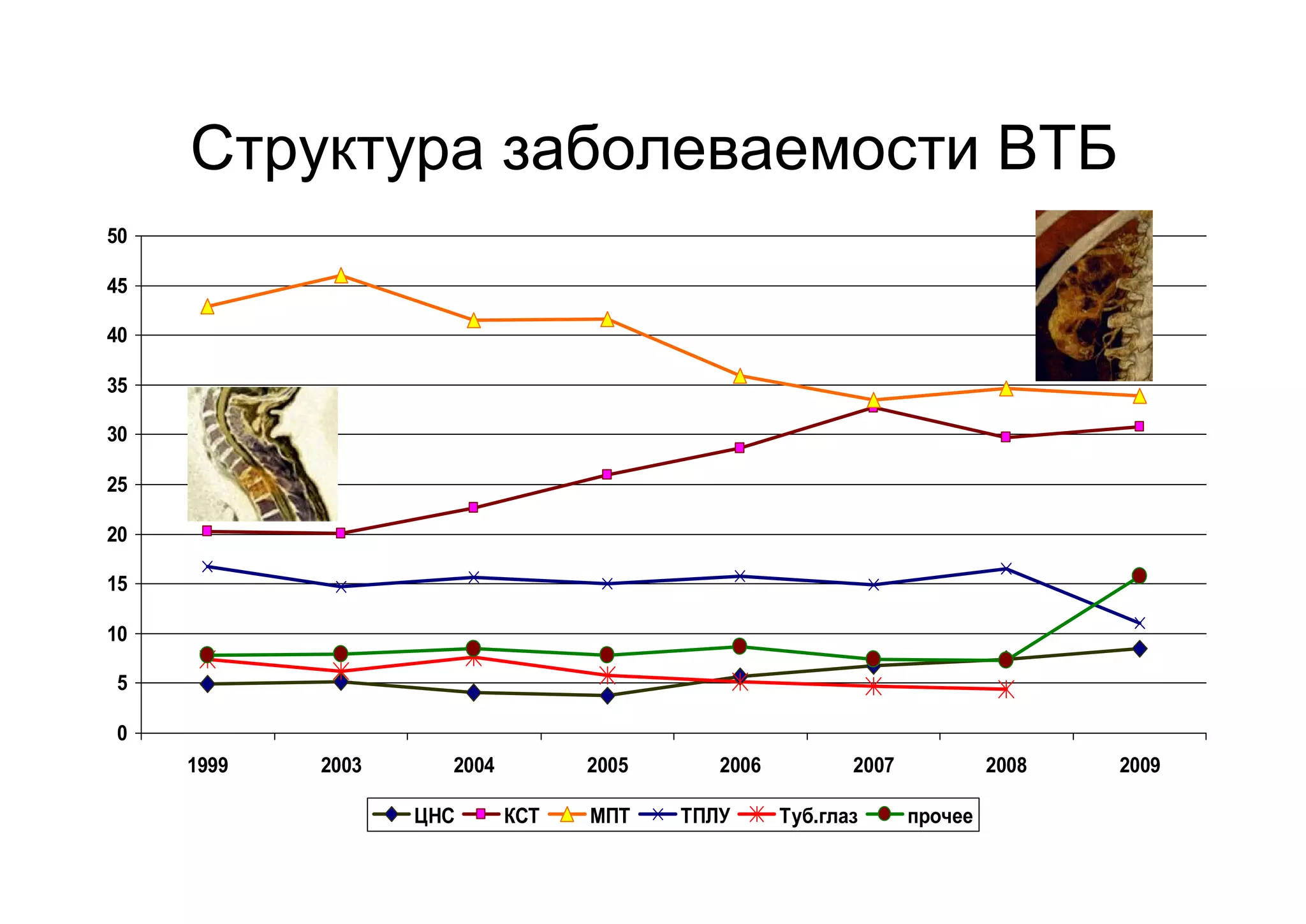 Структура заболеваемости ВТБ
50

45

40

35

30

25

20

15

10

5

0
     1999   2003     2004         2005      2006          2007            2008   2009

                   ЦНС      КСТ   МПТ    ТПЛУ      Туб.глаз      прочее
 