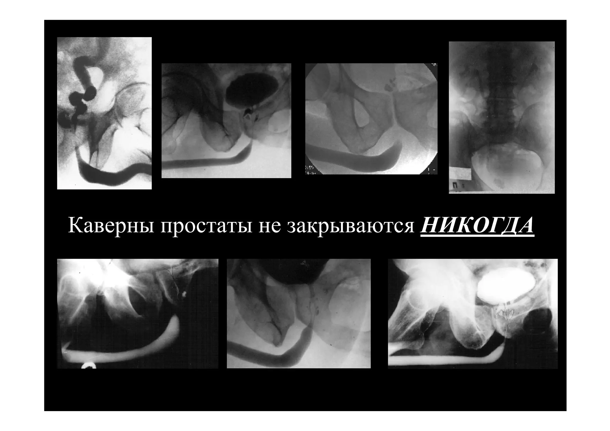 Каверны простаты не закрываются НИКОГДА
 