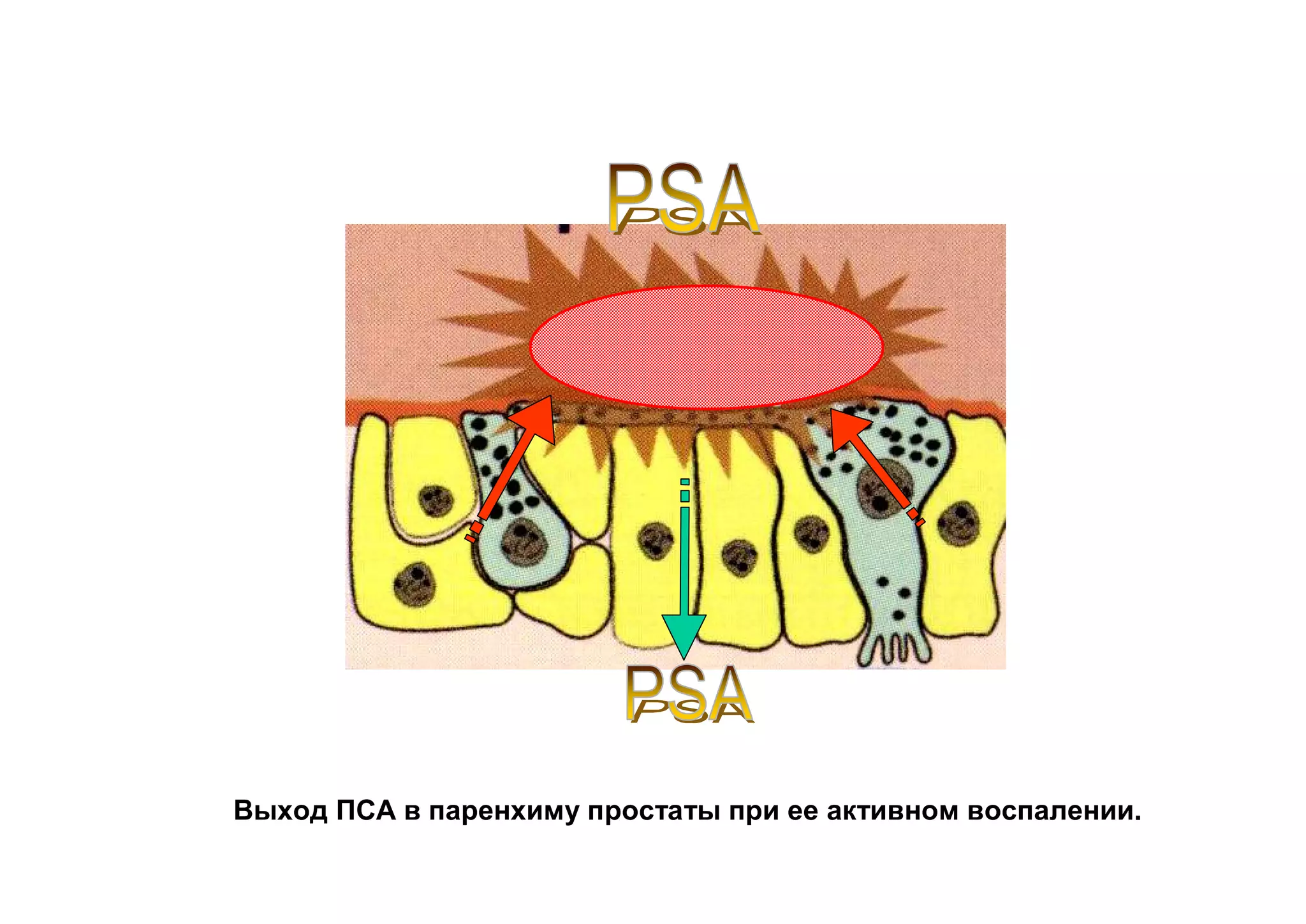 Выход ПСА в паренхиму простаты при ее активном воспалении.
 