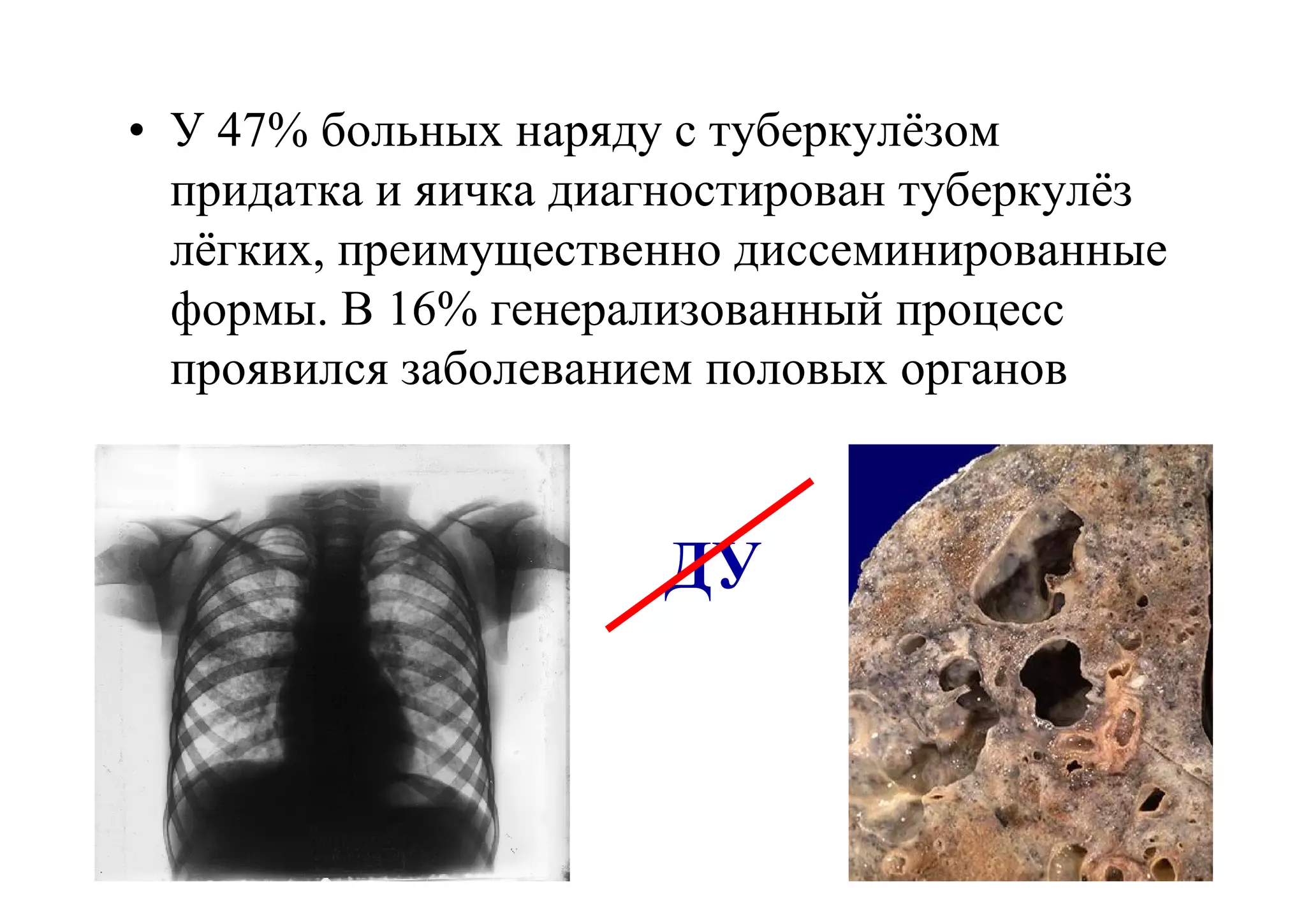 • У 47% больных наряду с туберкулёзом
  придатка и яичка диагностирован туберкулёз
  лёгких, преимущественно диссеминированные
  формы. В 16% генерализованный процесс
  проявился заболеванием половых органов



                      ДУ
 