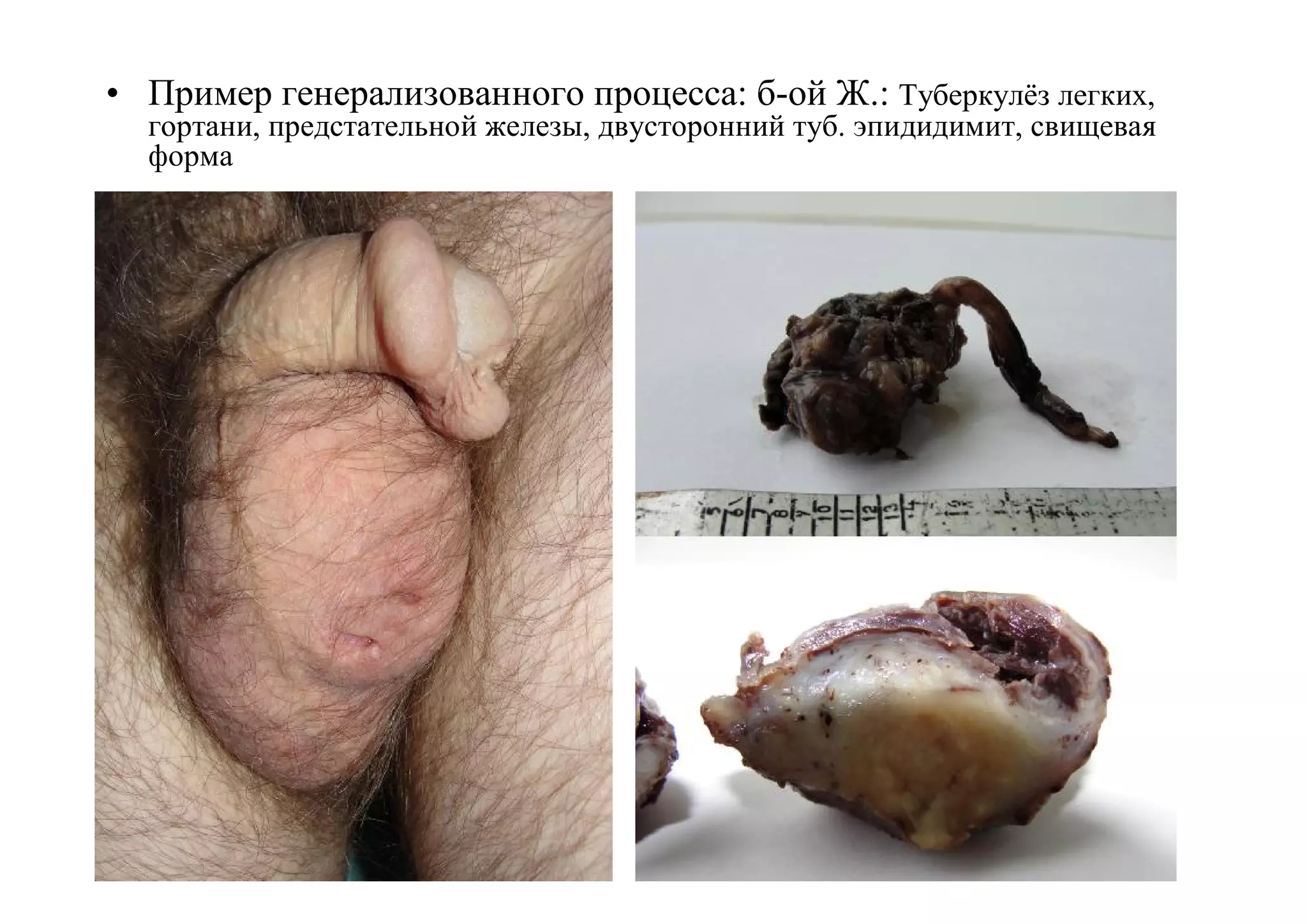 • Пример генерализованного процесса: б-ой Ж.: Туберкулёз легких,
  гортани, предстательной железы, двусторонний туб. эпидидимит, свищевая
  форма
 