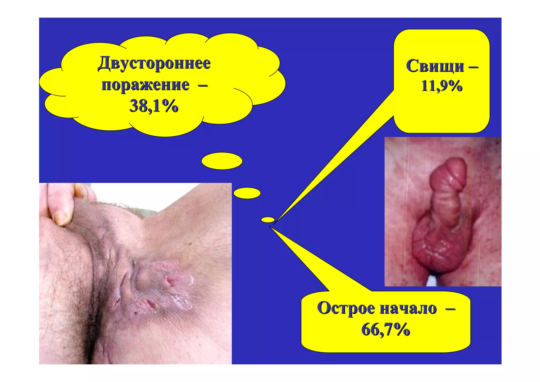 Двустороннее            Свищи –
поражение –               11,9%
   38,1%




               Острое начало –
                   66,7%
 