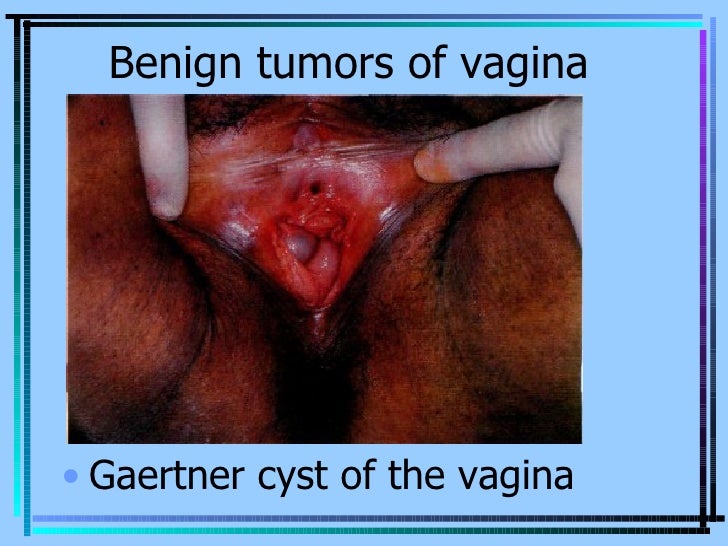 Benign Tumors In Vagina 75