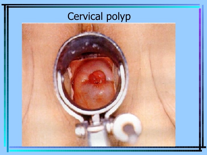 Vaginal lesion 1cm 2 girls 1 cock facial