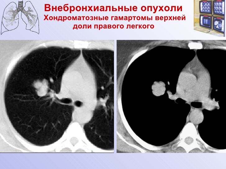 образования в легких на кт. очаговая пневмония кт. образования в легких на кт. кальцинаты в лёгких на кт. очаговая пневмония кт.