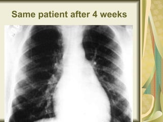 Same patient after 4 weeks   