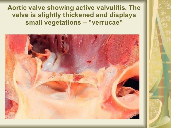 Aortic valve showing active valvulitis. The valve is slightly thickened and displays small vegetations – &quot;verrucae&qu...