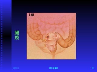腸癌 