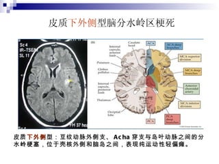 皮质 下外侧 型脑分水岭区梗死 皮质 下外侧 型：豆纹动脉外侧支、 Acha 穿支与岛叶动脉之间的分水岭梗塞，位于壳核外侧和脑岛之间，表现纯运动性轻偏瘫。 