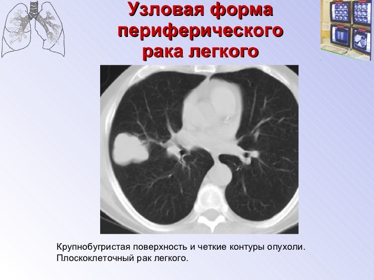 периферический рак легкого диагностика. периферические опухоли легких. периферическое новообразование легкого. узловая форма карциномы легкого. периферический рак легкого диагностика.