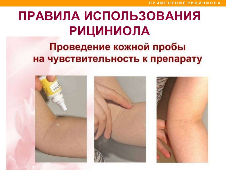 Можно ли вылечить псориаз ногтей