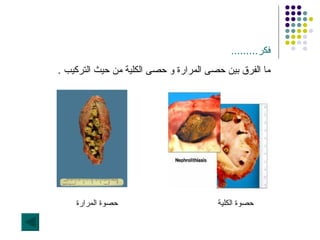 فكر ......... ما الفرق بين حصى المرارة و حصى الكلية من حيث التركيب  . حصوة الكلية حصوة المرارة 