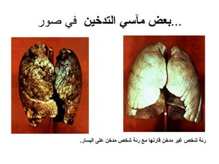 التدخين | PPT
