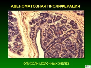 АДЕНОМАТОЗНАЯ ПРОЛИФЕРАЦИЯ ОПУХОЛИ МОЛОЧНЫХ ЖЕЛЕЗ 