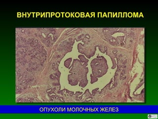 ВНУТРИПРОТОКОВАЯ ПАПИЛЛОМА ОПУХОЛИ МОЛОЧНЫХ ЖЕЛЕЗ 