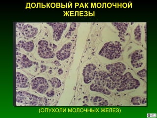 ДОЛЬКОВЫЙ РАК МОЛОЧНОЙ ЖЕЛЕЗЫ (ОПУХОЛИ МОЛОЧНЫХ ЖЕЛЕЗ) 