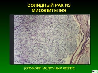 СОЛИДНЫЙ РАК ИЗ МИОЭПИТЕЛИЯ (ОПУХОЛИ МОЛОЧНЫХ ЖЕЛЕЗ) 