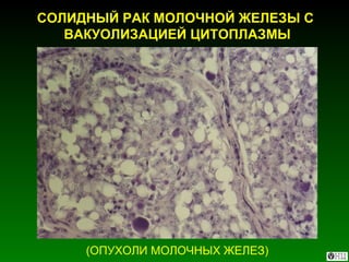 СОЛИДНЫЙ РАК МОЛОЧНОЙ ЖЕЛЕЗЫ С  ВАКУОЛИЗАЦИЕЙ ЦИТОПЛАЗМЫ (ОПУХОЛИ МОЛОЧНЫХ ЖЕЛЕЗ) 