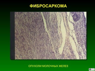 ФИБРОСАРКОМА ОПУХОЛИ МОЛОЧНЫХ ЖЕЛЕЗ 