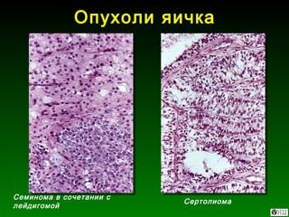 Опухоли яичка Семинома в сочетании с лейдигомой Сертолиома 