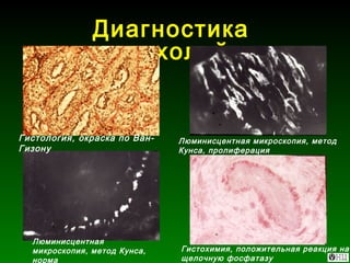 Диагностика опухолей Люминисцентная микроскопия, метод Кунса, пролиферация Гистология, окраска по Ван-Гизону Люминисцентная микроскопия, метод Кунса, норма Гистохимия, положительная реакция на щелочную фосфатазу 