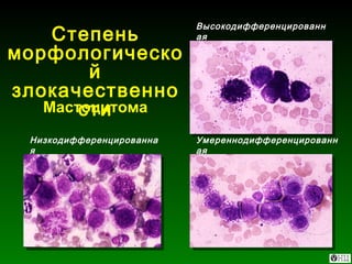 Низкодифференцированная Степень морфологической злокачественности Высокодифференцированная Умереннодифференцированная Мастоцитома 