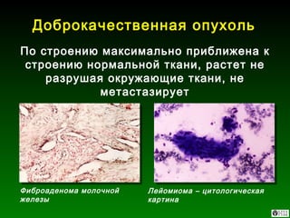 Доброкачественная опухоль По строению максимально приближена к строению нормальной ткани, растет не разрушая окружающие ткани, не метастазирует Фиброаденома молочной железы Лейомиома – цитологическая картина 