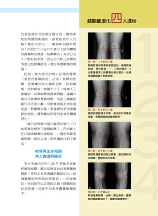 1
                                  腦瘤治療在花蓮
                                 退化性膝關節炎之治療新觀念



                         膝關節退化   四    大進程

口老化情形可說是全國之冠，關節老
化的問題如影隨形，是致使老年人行
動不便的主因之一。關節中心曾針對
四千四百七十八名六十歲以上接受體檢
的嘉義縣民調查，結果顯示，有百分之
十八點七的女性、百分之六點三的男性




                                             2
                         第一期：二十到四十歲
有退化性膝關節炎，發生率是歐美的兩        關節軟骨初期會有輕微發炎，表面稍微
倍。                       粗糙、彈性降低；一、二期的退化，X
                         光影像基本上較難看出退化徵兆，必須
 目前，絕大部分的病人在確定罹患
                         透過關節鏡才能更清楚。
「退化性膝關節炎」之後，就開始吃
藥、吃營養品防止關節退化，忍到最
後、拖到最後，膝蓋不行了，就換人工
膝關節。如果期間使用類固醇，連續六
個月可能導致骨質疏鬆，而吃止痛藥的




                                             3
副作用不容小覷，可能會造成上消化道
出血、影響腎功能，更重要的是加速關        第二期：四十到五十歲
節的退化，還有難以恢復的全身性體質        關節表面變得不平整，發炎部位有隆起
                         現象，骨骼間隙開始變得狹窄。
惡化。
 「真的沒有辦法阻止關節的退化，只
能等著時間到了換關節嗎？」呂紹睿主
任在臨床醫療的過程中，一直思索著這
個問題。幾年之後，居然讓他找到了解




                                             4
法。

      軟骨再生非奇蹟            第三期：五十到六十歲
                         關節軟骨隆起的部份破裂，變成鬚絲狀
      病人實證解膝苦            的組織，骨骼也長出骨刺。

 五十多歲的江先生 ( 化名 ) 長年來辛勤
經營荔枝園，最近卻被宣判必須要置換
關節。來到大林慈濟醫院關節中心，經
過簡單的手術就出院返家，一年後複
診，他已經可以正常的走路，膝關節的
狀況恢復，已經不用去考慮置換關節
                         第四期：六十歲以上
了。
                         軟骨逐漸裂開、分解，露出骨頭，膝關
                         節的間隙就消失了，關節也嚴重變形。
                                                  21
                                             人醫心傳
                                                 2010年6月
 