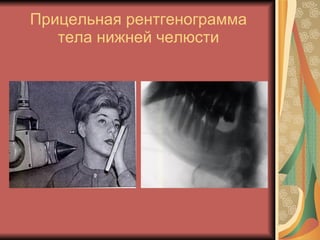 Прицельная рентгенограмма тела нижней челюсти 