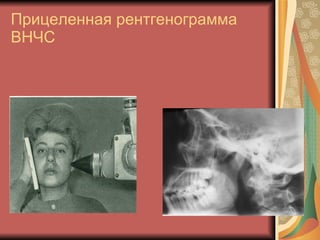 Прицеленная рентгенограмма ВНЧС 