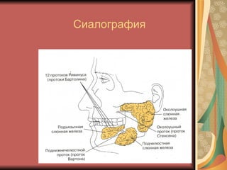 Сиалография 