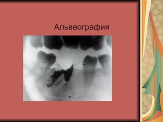 Альвеография 